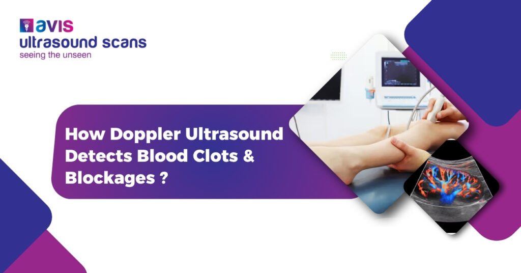 How Doppler Ultrasound Detects Blood Clots & Blockages